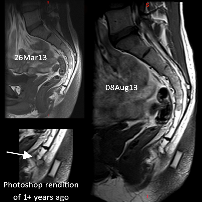 coccyx MRI